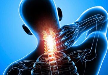 douleur intense au cou avec ostéochondrose avancée
