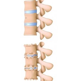 colonne vertébrale et colonne vertébrale saines affectées par l'ostéochondrose