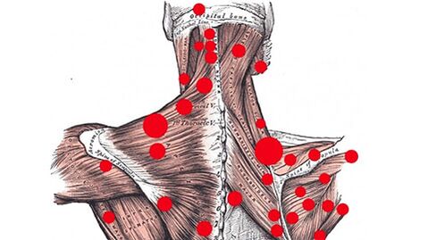 Points de déclenchement dans les muscles qui provoquent des maux de dos myofasciaux