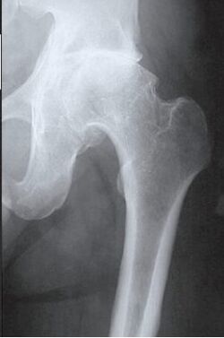 IRM de l'articulation de la hanche touchée