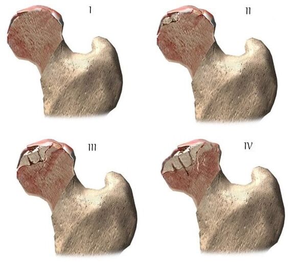 stades de l'arthrose de l'articulation de la hanche