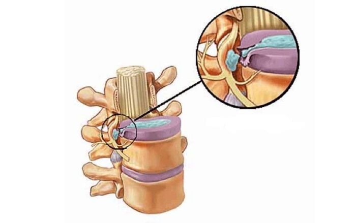 hernie intervertébrale avec ostéochondrose thoracique