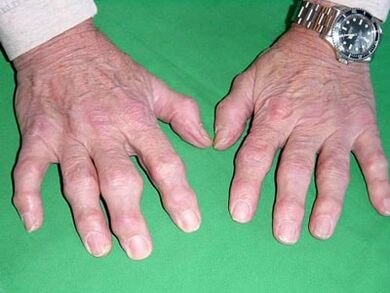 arthrose des doigts
