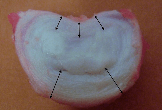 à quoi ressemble un disque intervertébral