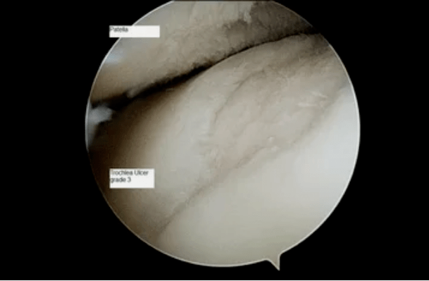 vue astroscopique d'une articulation du genou avec arthrose du 3ème degré